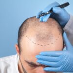 Understanding the Cost of Hair Transplantation in India: A Comprehensive Guide