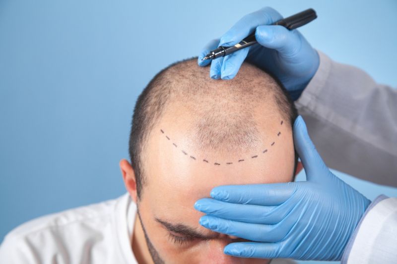 Cost of hair transplantation in india