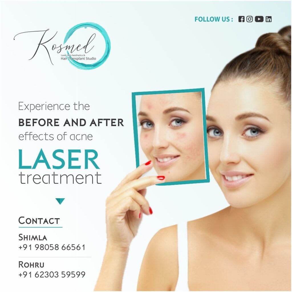 Laser skin whitening treatment before and after