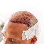 FUE Hair Transplant: A Comprehensive Guide to Restoring Your Hair