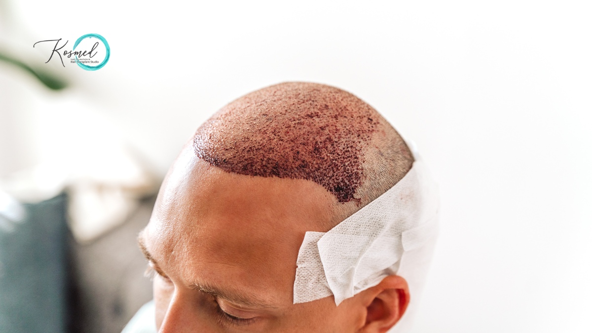 FUE Hair Transplant