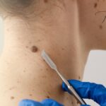 Freckle Removal in Shimla: Methods, Tips, and FAQs